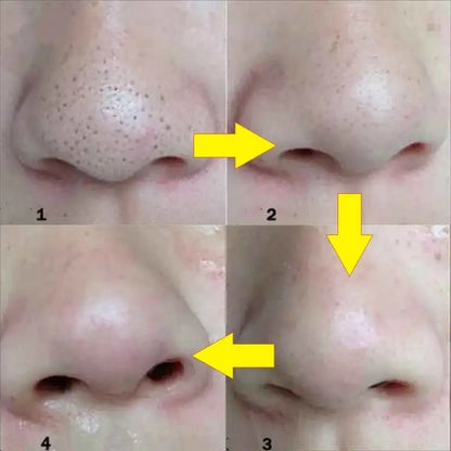 Blackhead Mask Peel Nasal Strips